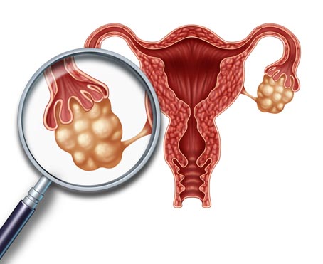 Síndrome de Ovarios Poliquísticos
