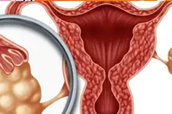FERTILIDAD ACUPUNTURA ovarios poliquisticos tile